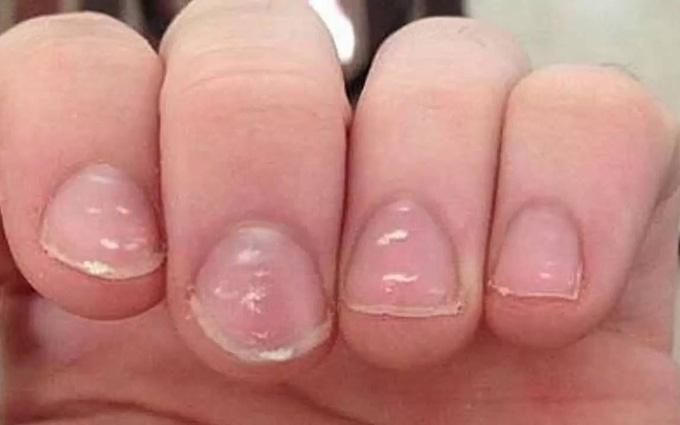 Dấu hiệu cần bổ sung Vitamin B