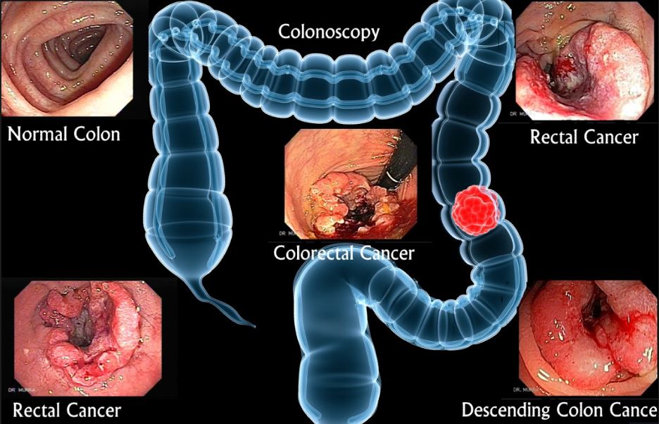 RUỘT SẠCH để ngăn ngừa UNG THƯ.