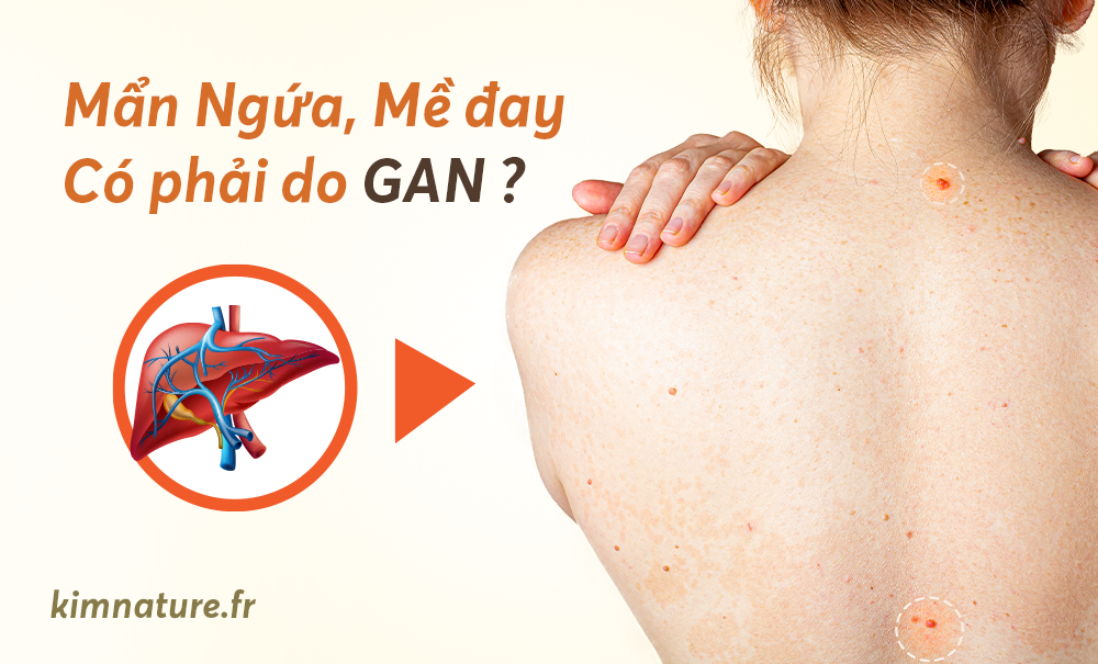 Da dễ bị ngứa, nổi mụn và mề đay – Có phải do Gan?